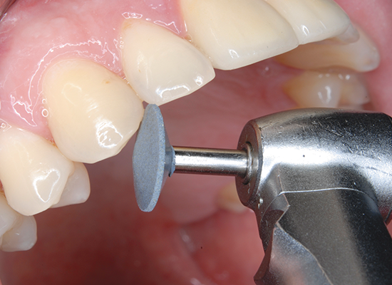 Shofu CeraMaster Coarse and CeraMaster 3 Pack