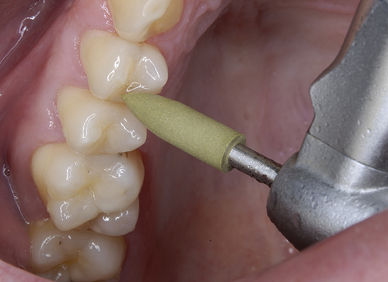 Shofu CompoMaster and CompoMaster Coarse