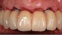 Aidite 3D PRO Dental Zirconia Disc 98mm x 22mm, Shade C1 thumbnail 4