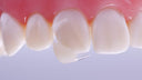 Directa CoForm 31-32 Mesial Sectional Matrix thumbnail 4