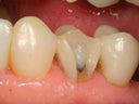 Pulpdent Embrace WetBond Restoration & PFM Repair Kit thumbnail 4