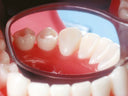 Pulpdent Flecta Disposable Mouth Mirrors, 200/Box thumbnail 2
