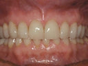 Pulpdent Kleer-Veneer, Clear Shade, 1.2 mL Syringe thumbnail 4